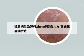 銀屑病能治好嗎zhen好西安北方 西安銀屑病治療