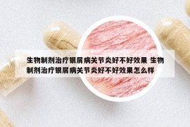 生物制劑治療銀屑病關(guān)節(jié)炎好不好效果 生物制劑治療銀屑病關(guān)節(jié)炎好不好效果怎么樣