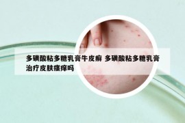 多磺酸粘多糖乳膏牛皮癬 多磺酸粘多糖乳膏治療皮膚瘙癢嗎