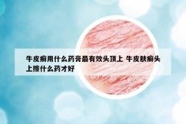 牛皮癬用什么藥膏最有效頭頂上 牛皮膚癬頭上擦什么藥才好