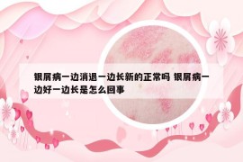 銀屑病一邊消退一邊長新的正常嗎 銀屑病一邊好一邊長是怎么回事