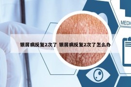 銀屑病反復(fù)2次了 銀屑病反復(fù)2次了怎么辦