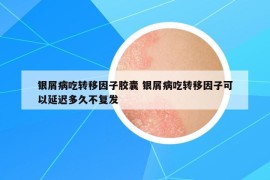 銀屑病吃轉(zhuǎn)移因子膠囊 銀屑病吃轉(zhuǎn)移因子可以延遲多久不復(fù)發(fā)