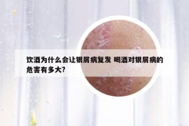 飲酒為什么會(huì)讓銀屑病復(fù)發(fā) 喝酒對(duì)銀屑病的危害有多大?