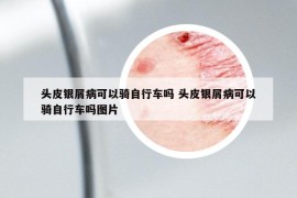 頭皮銀屑病可以騎自行車嗎 頭皮銀屑病可以騎自行車嗎圖片