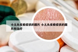 小兒頭皮癬癥狀的圖片 小兒頭皮癬癥狀的圖片和治療