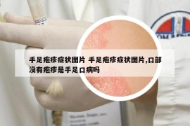 手足皰疹癥狀圖片 手足皰疹癥狀圖片,口部沒有皰疹是手足口病嗎