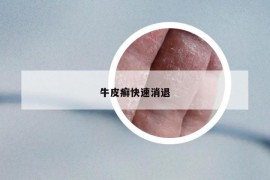 牛皮癬快速消退