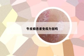 牛皮癬患者免疫力低嗎