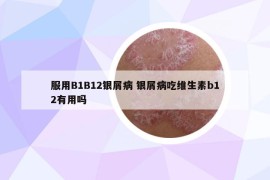 服用B1B12銀屑病 銀屑病吃維生素b12有用嗎