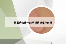 銀屑病吃些什么好 銀屑病吃什么呀