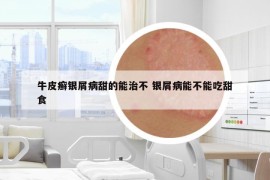 牛皮癬銀屑病甜的能治不 銀屑病能不能吃甜食