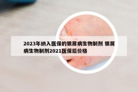 2023年納入醫(yī)保的銀屑病生物制劑 銀屑病生物制劑2021醫(yī)保后價(jià)格