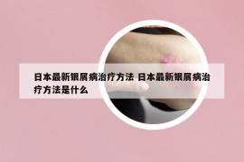 日本最新銀屑病治療方法 日本最新銀屑病治療方法是什么