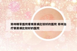 鄭州哪家醫(yī)院看銀屑病比較好的醫(yī)院 鄭州治療銀屑病比較好的醫(yī)院