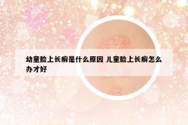 幼童臉上長(zhǎng)癬是什么原因 兒童臉上長(zhǎng)癬怎么辦才好