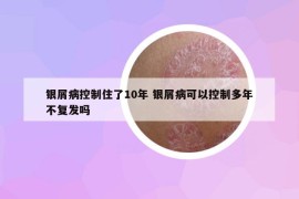 銀屑病控制住了10年 銀屑病可以控制多年不復(fù)發(fā)嗎