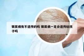 銀屑病有不遺傳的嗎 銀屑病一定會遺傳給孩子嗎