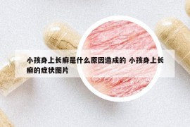 小孩身上長癬是什么原因造成的 小孩身上長癬的癥狀圖片