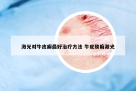 激光對牛皮癬最好治療方法 牛皮膚癬激光