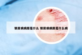 銀屑病病原是什么 銀屑病病原是什么病