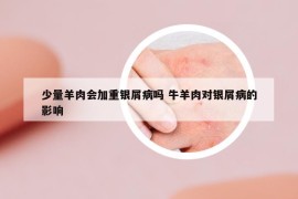 少量羊肉會加重銀屑病嗎 牛羊肉對銀屑病的影響