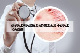 孩子頭上有頭皮癬怎么辦要怎么流 小孩頭上長頭皮癬