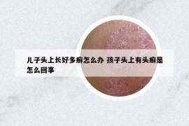 兒子頭上長好多癬怎么辦 孩子頭上有頭癬是怎么回事