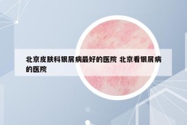 北京皮膚科銀屑病最好的醫(yī)院 北京看銀屑病的醫(yī)院