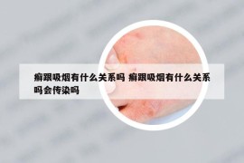 癬跟吸煙有什么關(guān)系嗎 癬跟吸煙有什么關(guān)系嗎會(huì)傳染嗎