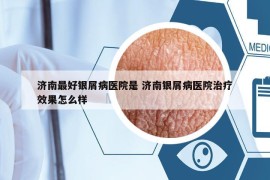 濟(jì)南最好銀屑病醫(yī)院是 濟(jì)南銀屑病醫(yī)院治療效果怎么樣