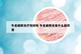 牛皮癬照光療效好嗎 牛皮癬照光有什么副作用