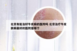 北京有能治好牛皮癬的醫(yī)院嗎 北京治療牛皮膚癬最好的醫(yī)院是哪個(gè)