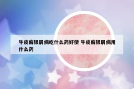 牛皮癬銀屑病吃什么藥好使 牛皮癬銀屑病用什么藥