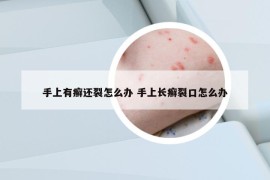 手上有癬還裂怎么辦 手上長(zhǎng)癬裂口怎么辦