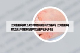 注射用胸腺五肽對銀屑病有效果嗎 注射用胸腺五肽對銀屑病有效果嗎多少錢