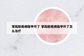 掌跖膿皰病指甲壞了 掌跖膿皰病指甲壞了怎么治療