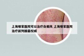 上海哪家醫(yī)院可以治療白癜風(fēng) 上海哪家醫(yī)院治療前列腺最權(quán)威