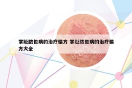 掌趾膿包病的治療偏方 掌趾膿包病的治療偏方大全