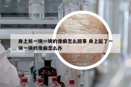 身上長一塊一塊的像癬怎么回事 身上起了一塊一塊的像癬怎么辦