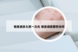 銀屑病多久照一次光 銀屑病需要照光嗎