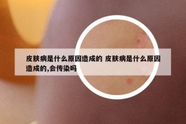 皮膚病是什么原因造成的 皮膚病是什么原因造成的,會(huì)傳染嗎