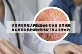 銀屑病能用復(fù)方丙酸氯倍他索軟膏 銀屑病用復(fù)方丙酸氯倍他索軟膏過(guò)敏還可以抹什么藥