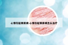 心情引起銀屑病 心情引起銀屑病怎么治療