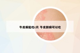 牛皮癬能吃c片 牛皮膚癬可以吃
