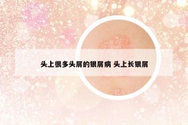 頭上很多頭屑的銀屑病 頭上長銀屑