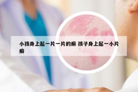 小孩身上起一片一片的癬 孩子身上起一小片癬