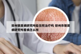 鄭州銀屑病研究所能住院治療嗎 鄭州市銀屑病研究所看病怎么樣