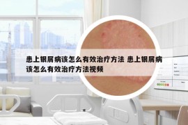 患上銀屑病該怎么有效治療方法 患上銀屑病該怎么有效治療方法視頻