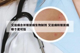 艾滋病合并銀屑病生物制劑 艾滋病和銀屑病哪個(gè)更可怕